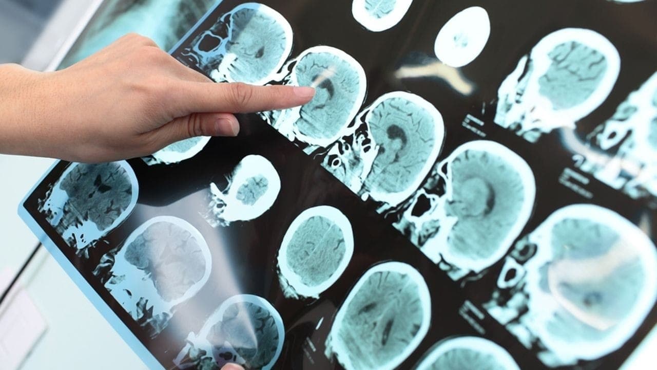 Alzheimer