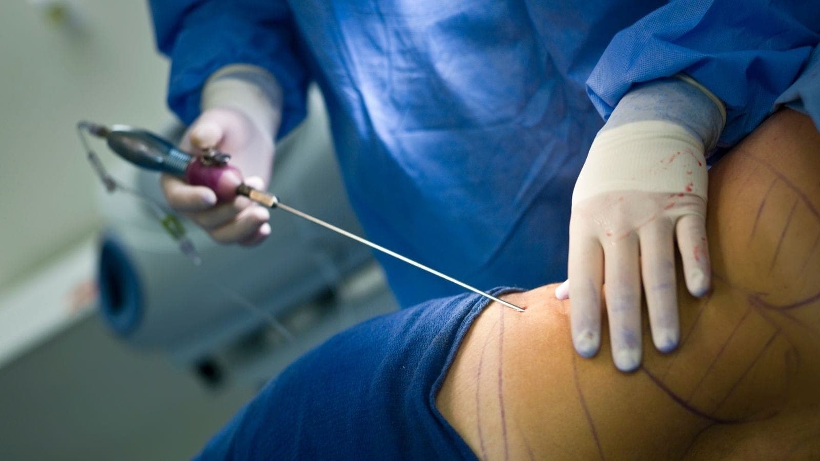 Lipoaspiração é cada vez mais popular