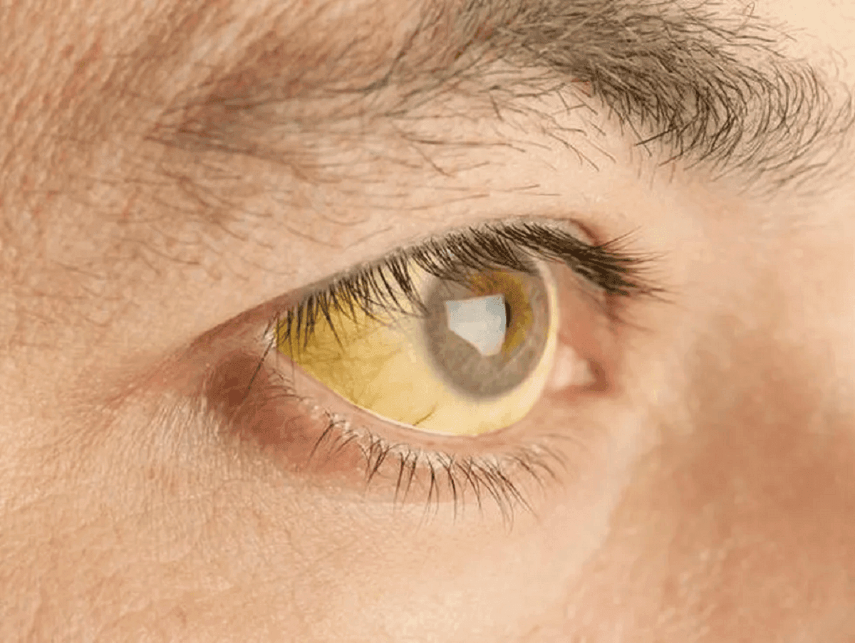 O sinal nos olhos que indica a gravidade da febre amarela