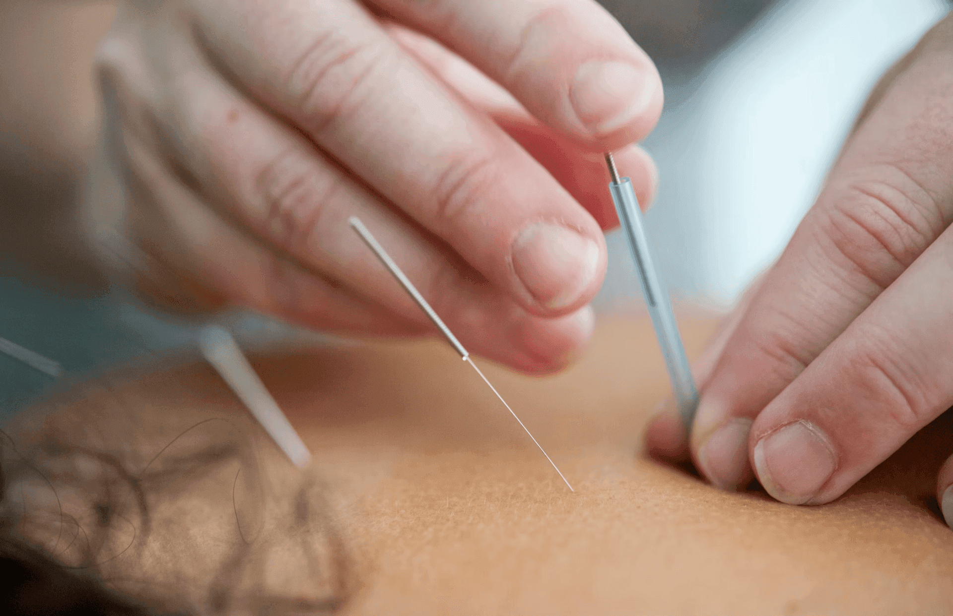 Acupuntura médica
