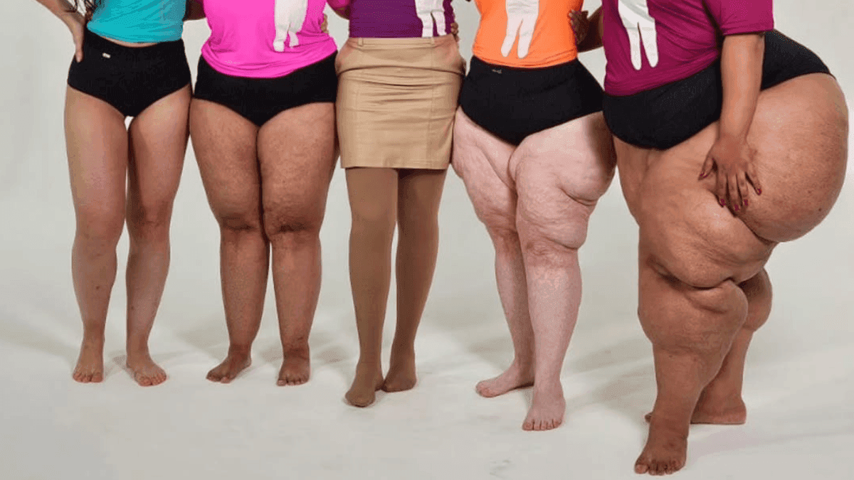 Lipedema