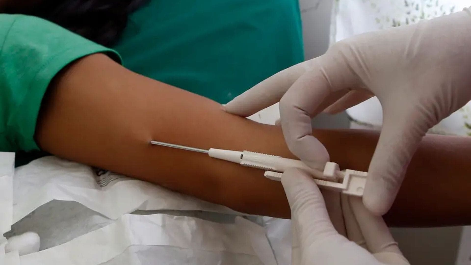 Implanon é colocado no braço e dura três anos