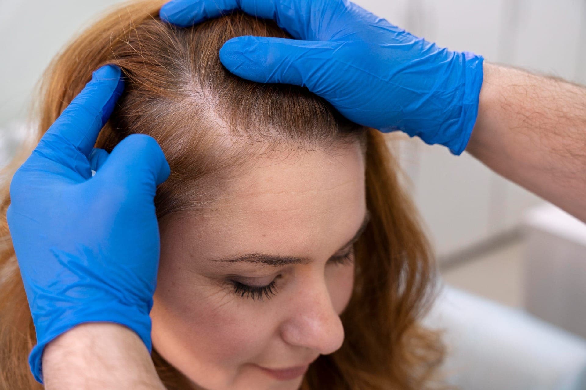 Alopecia