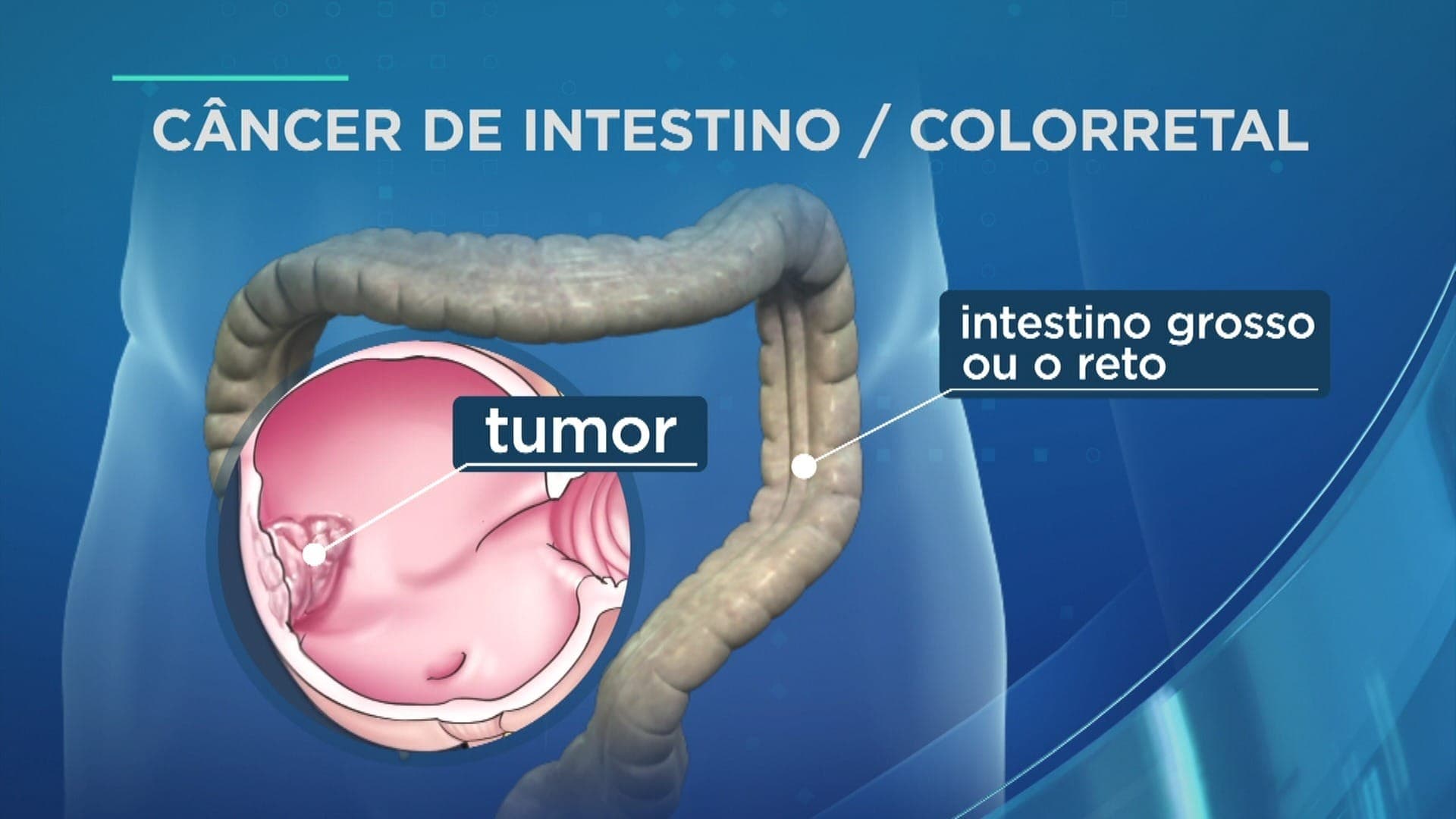 Câncer colorretal pode ser prevenido com estilo de vida mais saudável