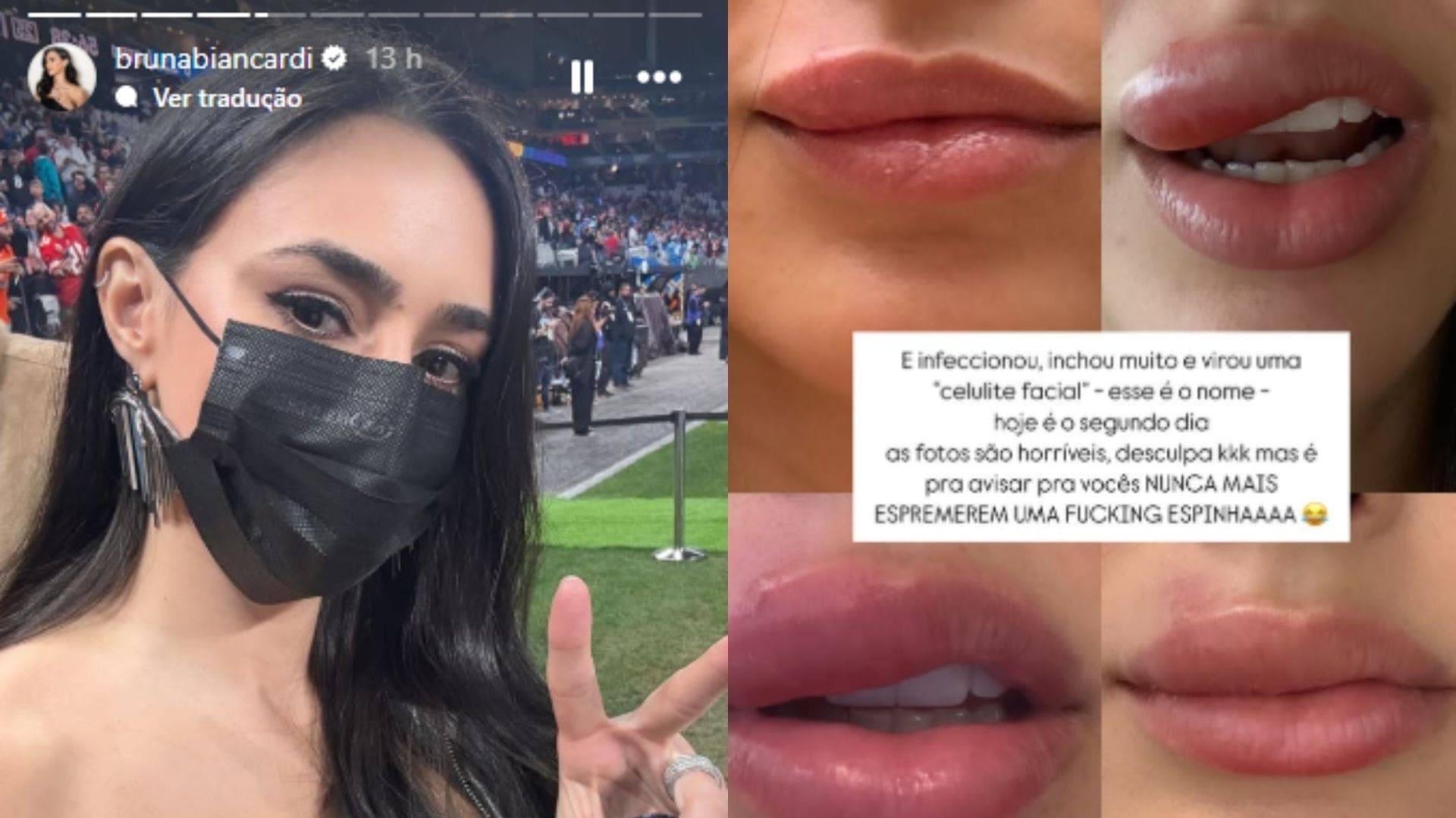 Bruna Biancardi tem celulite facial