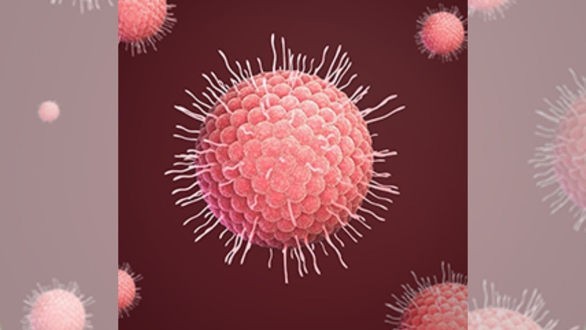 Herpes Zoster
