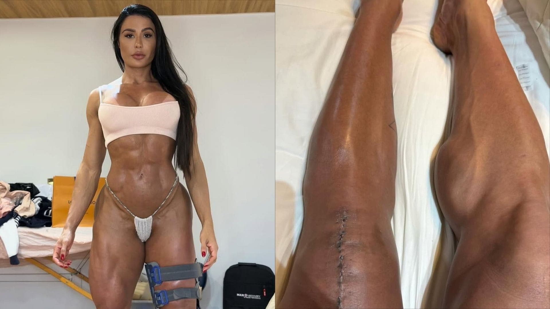 Gracyanne Barbosa mostra cicatriz de cirurgia