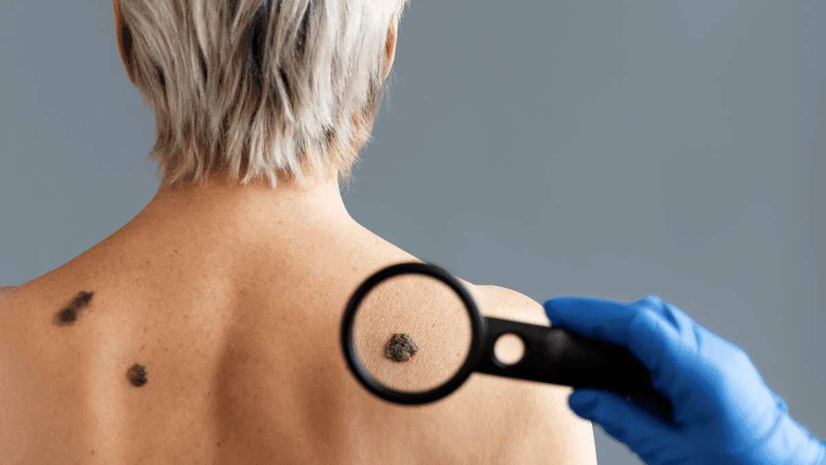 Melanoma