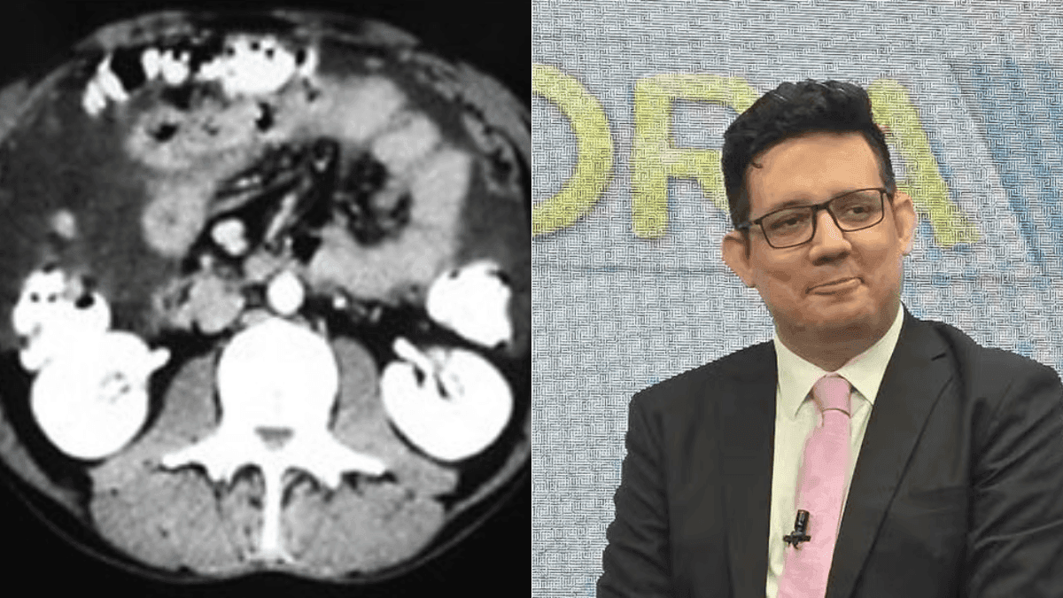 O que é tuberculose peritoneal?