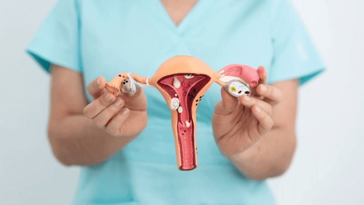 Endometriose