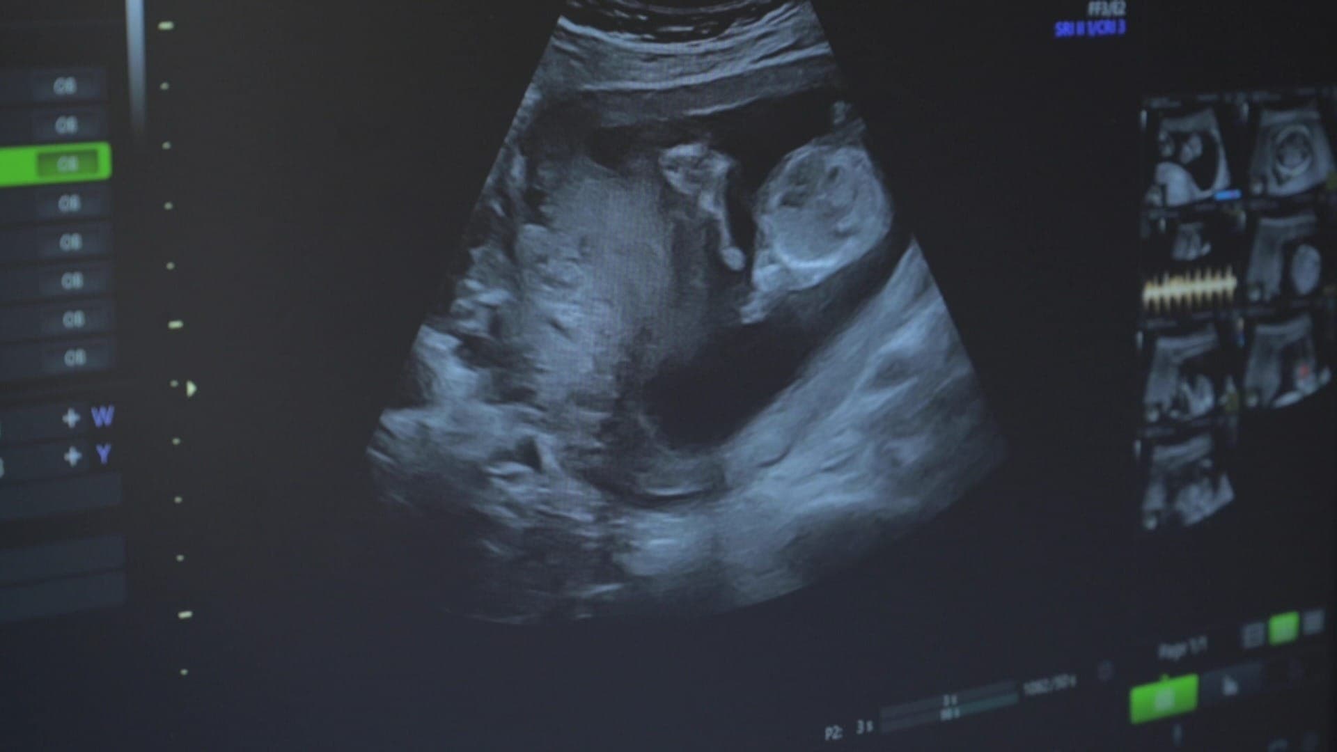 Proposta para impedir aborto legal no Brasil avança na Câmara dos Deputados