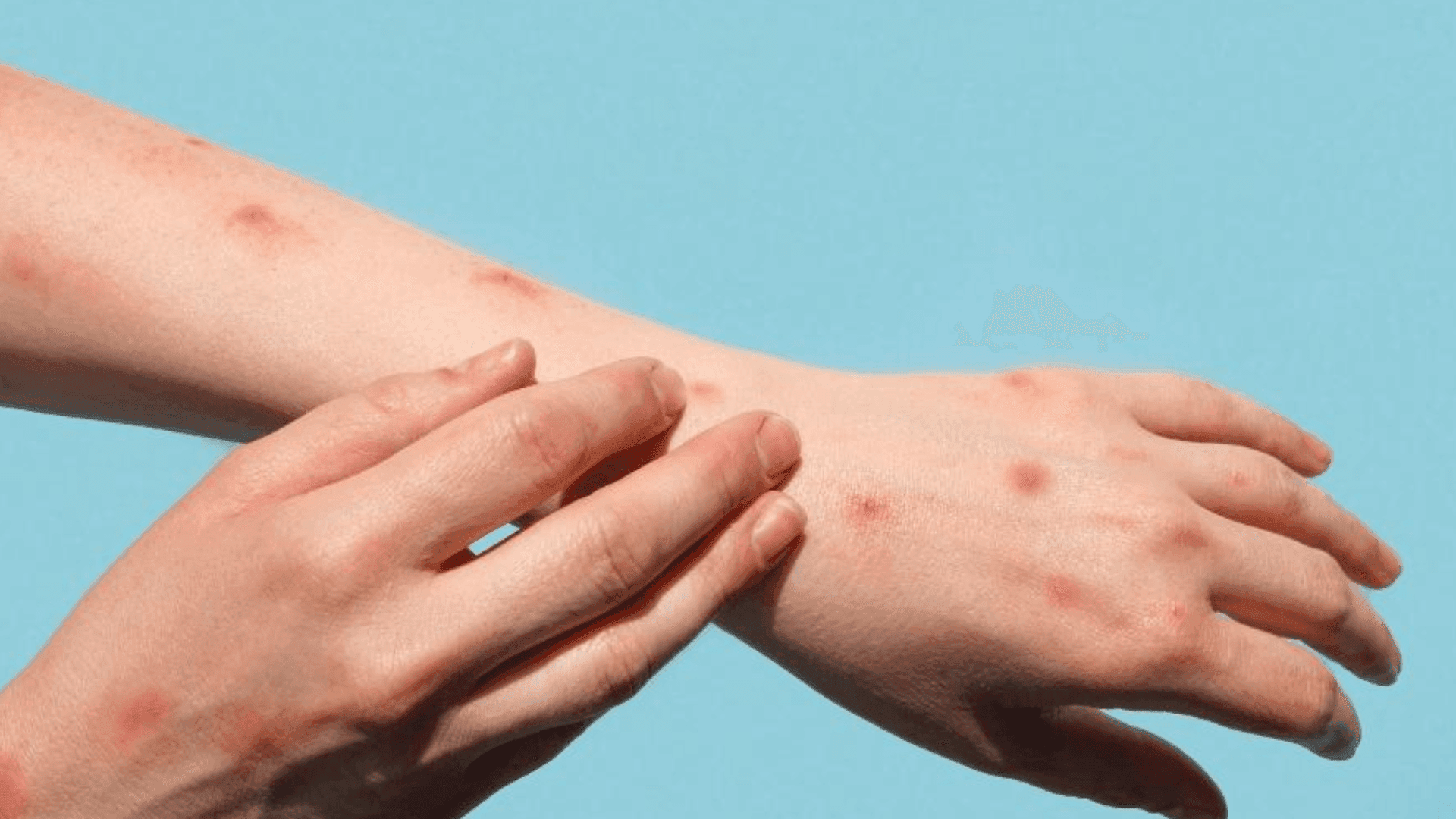 Mpox