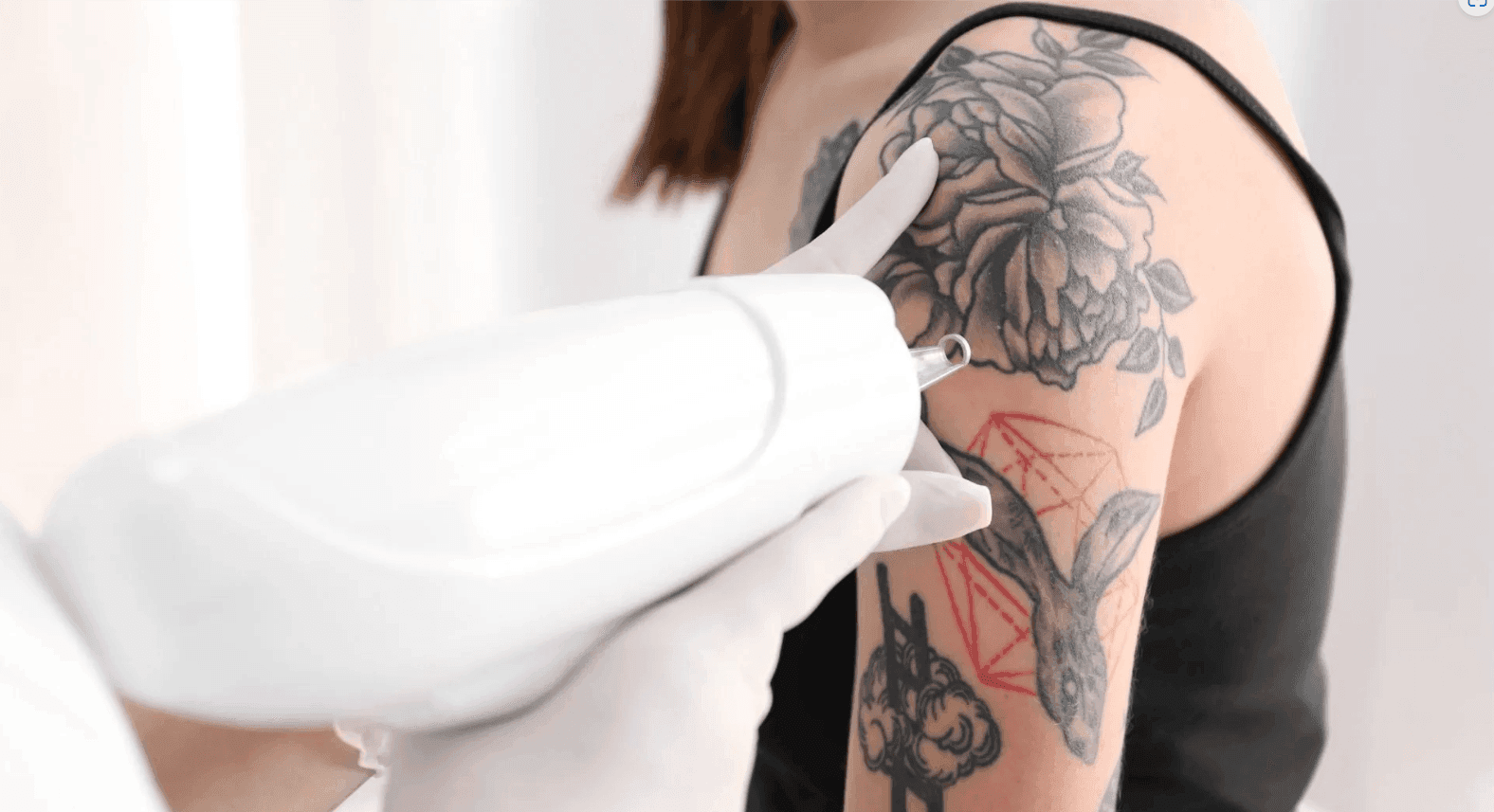Remoção de tatuagens a laser