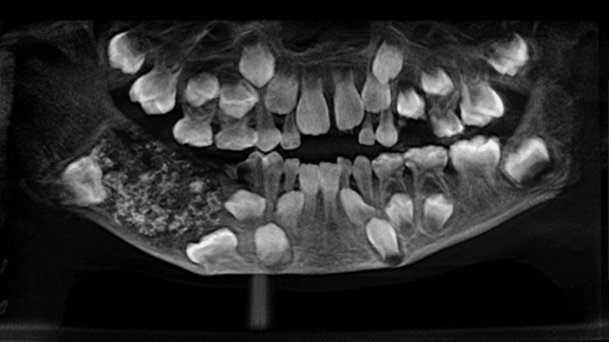 Criança retira 526 dentes em cirurgia