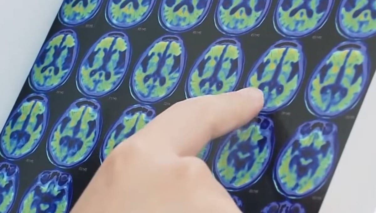 Anvisa aprova novo medicamento para tratamento de Alzheimer