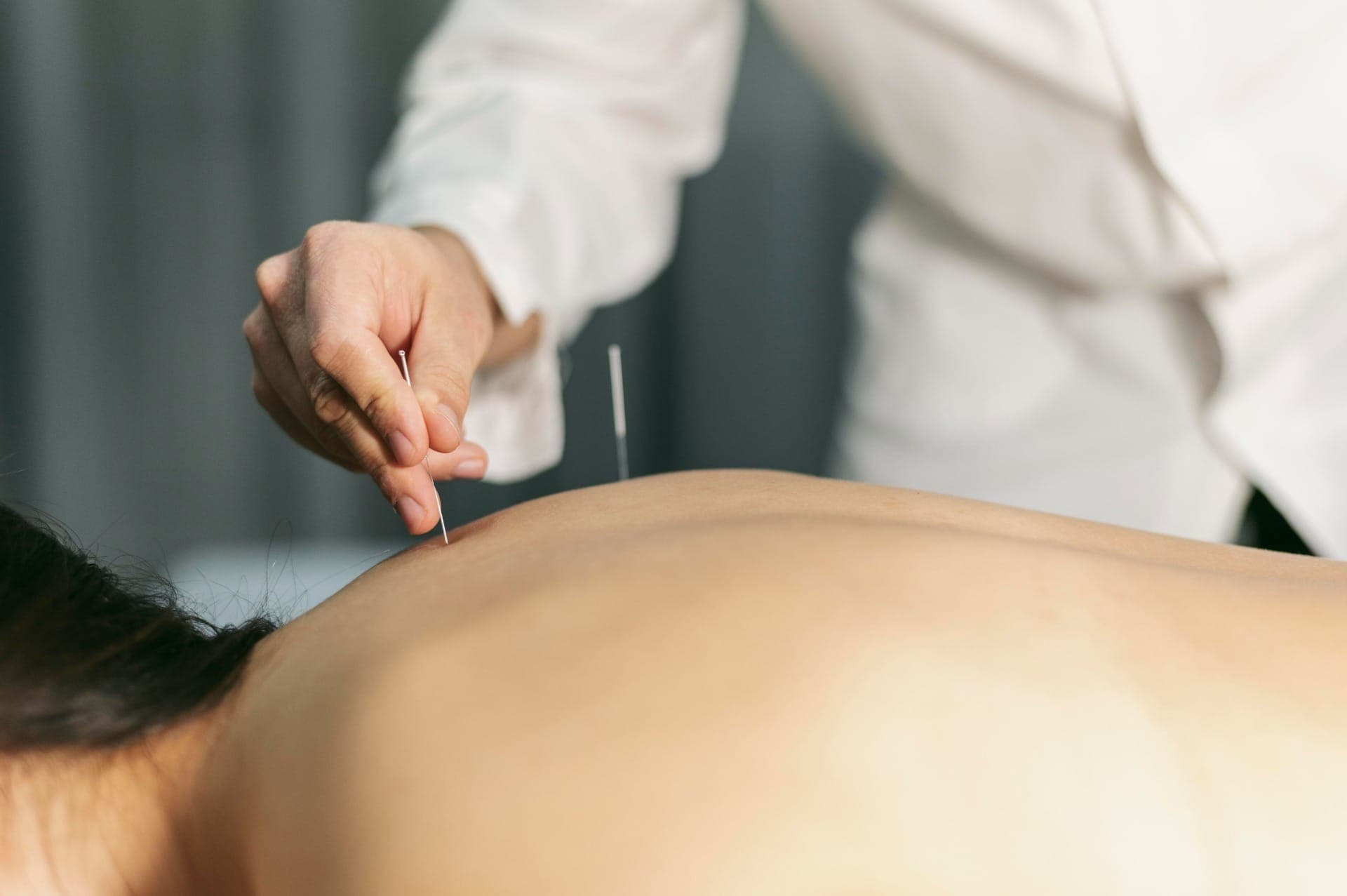 A acupuntura é uma das técnicas mais conhecidas da Medicina Tradicional Chinesa