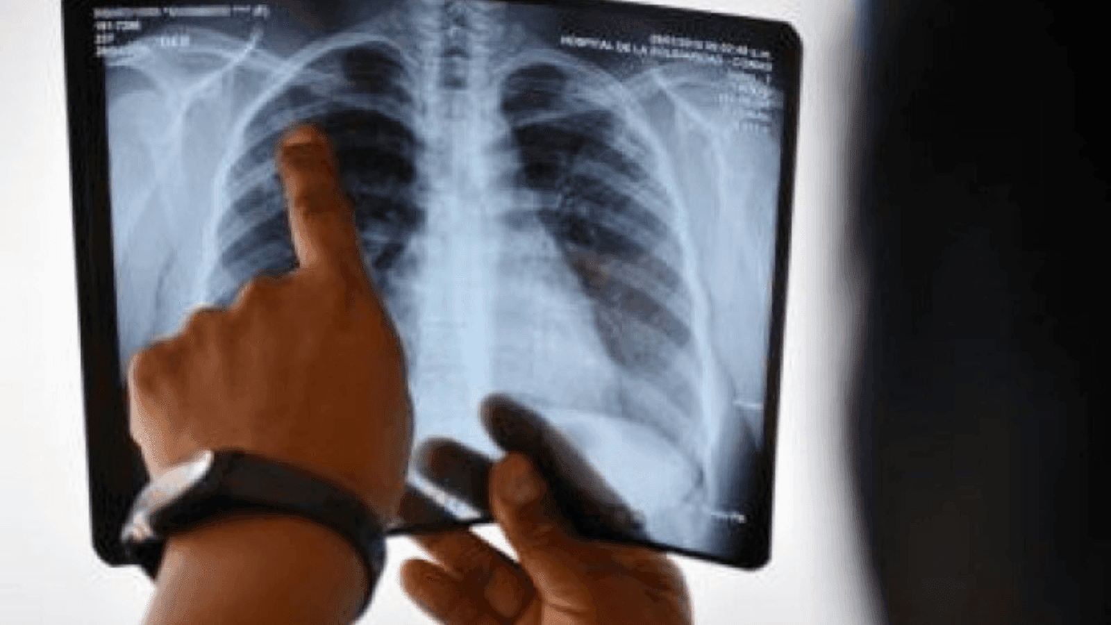 O principal sintoma da tuberculose pulmonar é a tosse