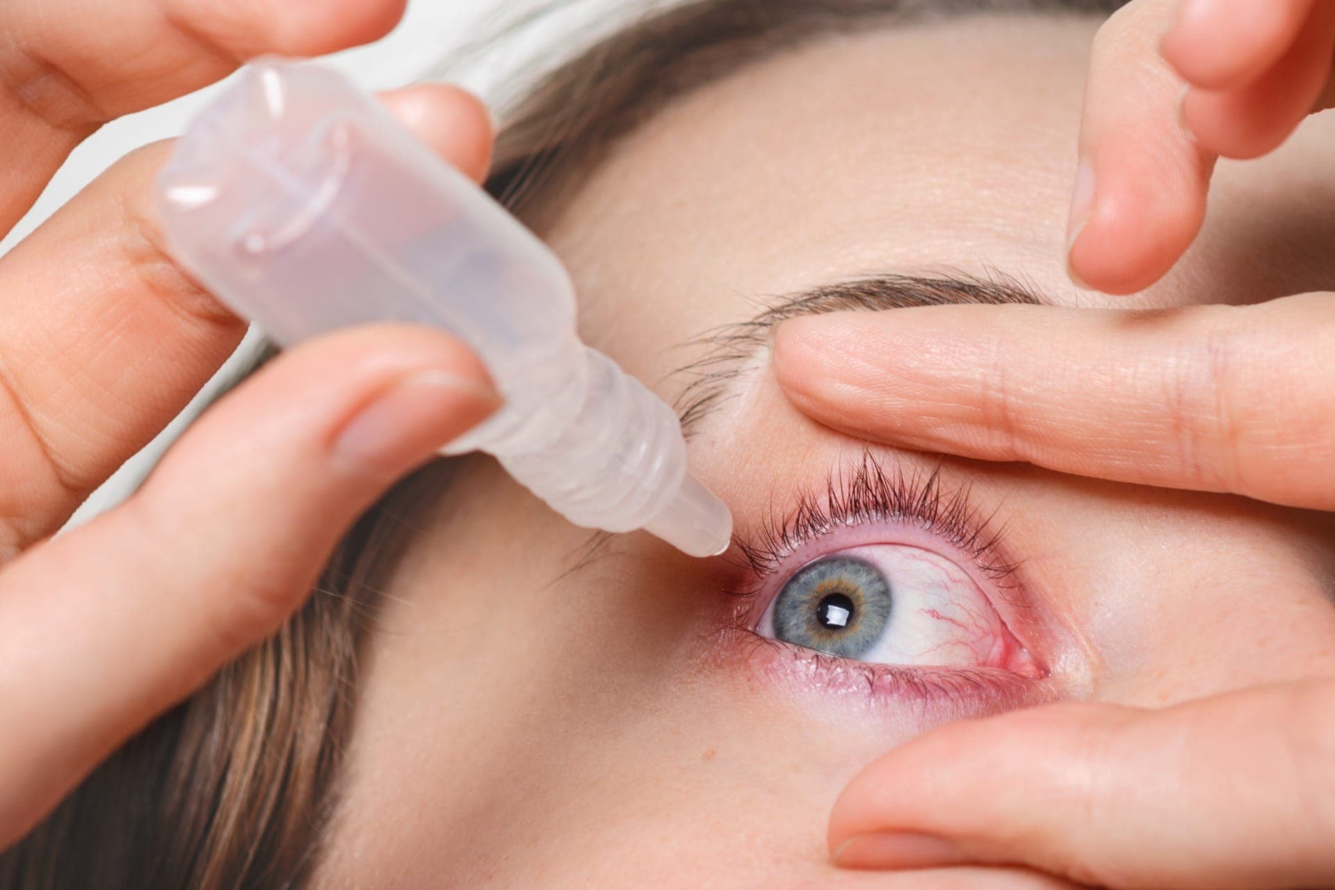 Conjuntivite causa olhos vermelhos e pode ser viral, bacteriana ou alérgica