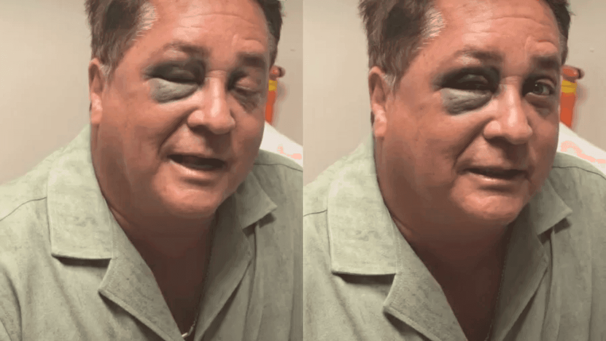 Leonardo sofre acidente e fica com olho roxo