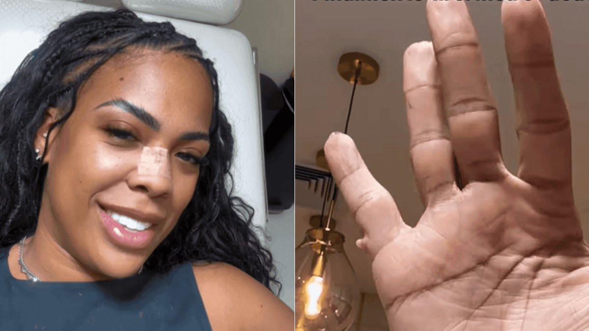 Marvvila passa por cirurgia para remover sexto dedo da mão