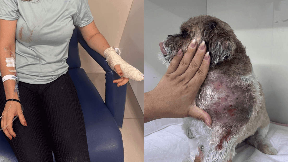 Mulher atacada por cachorro em SJCampos corre risco de perder um dedo
