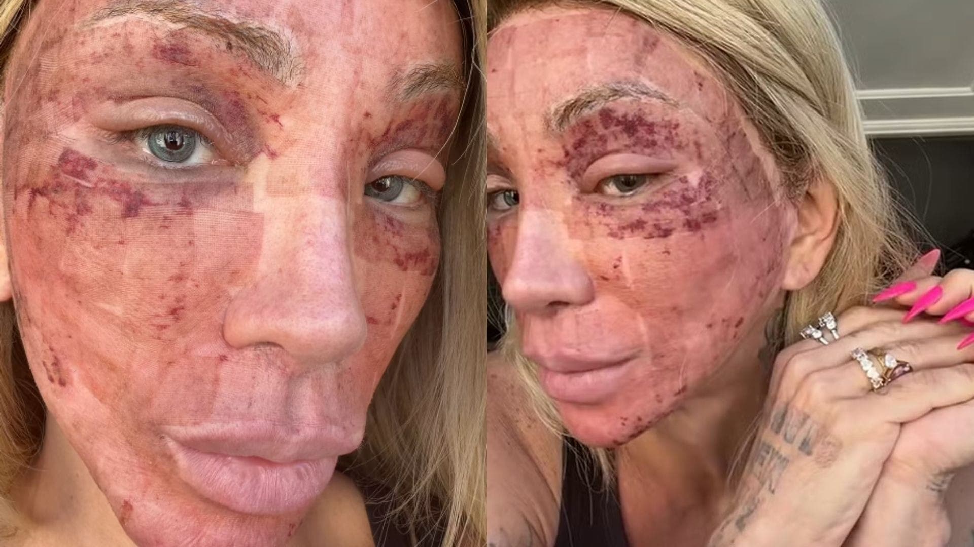 Maya Massafera mostrou resultado do peeling
