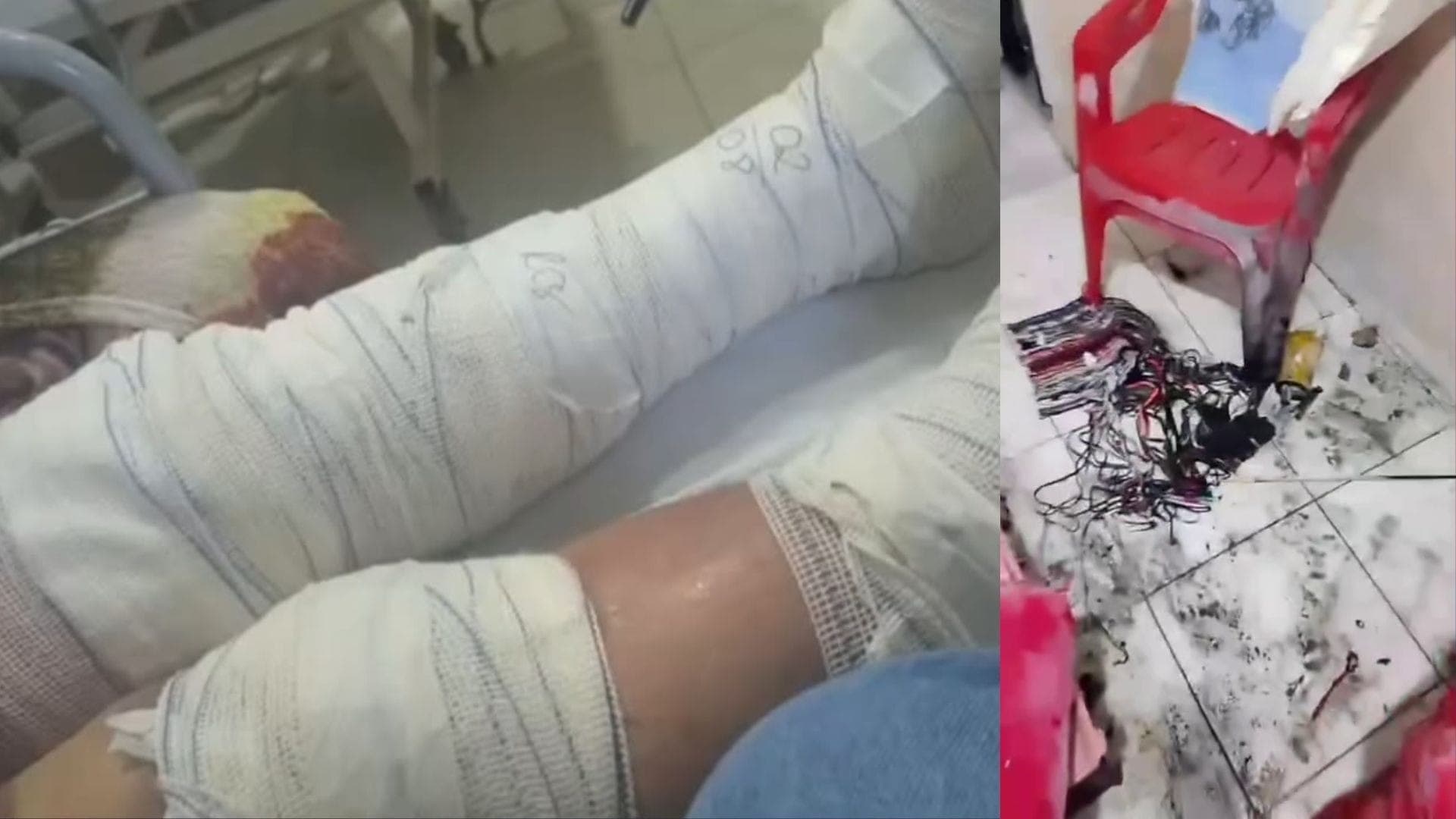 Idosa de 76 anos sofreu queimaduras de segundo grau