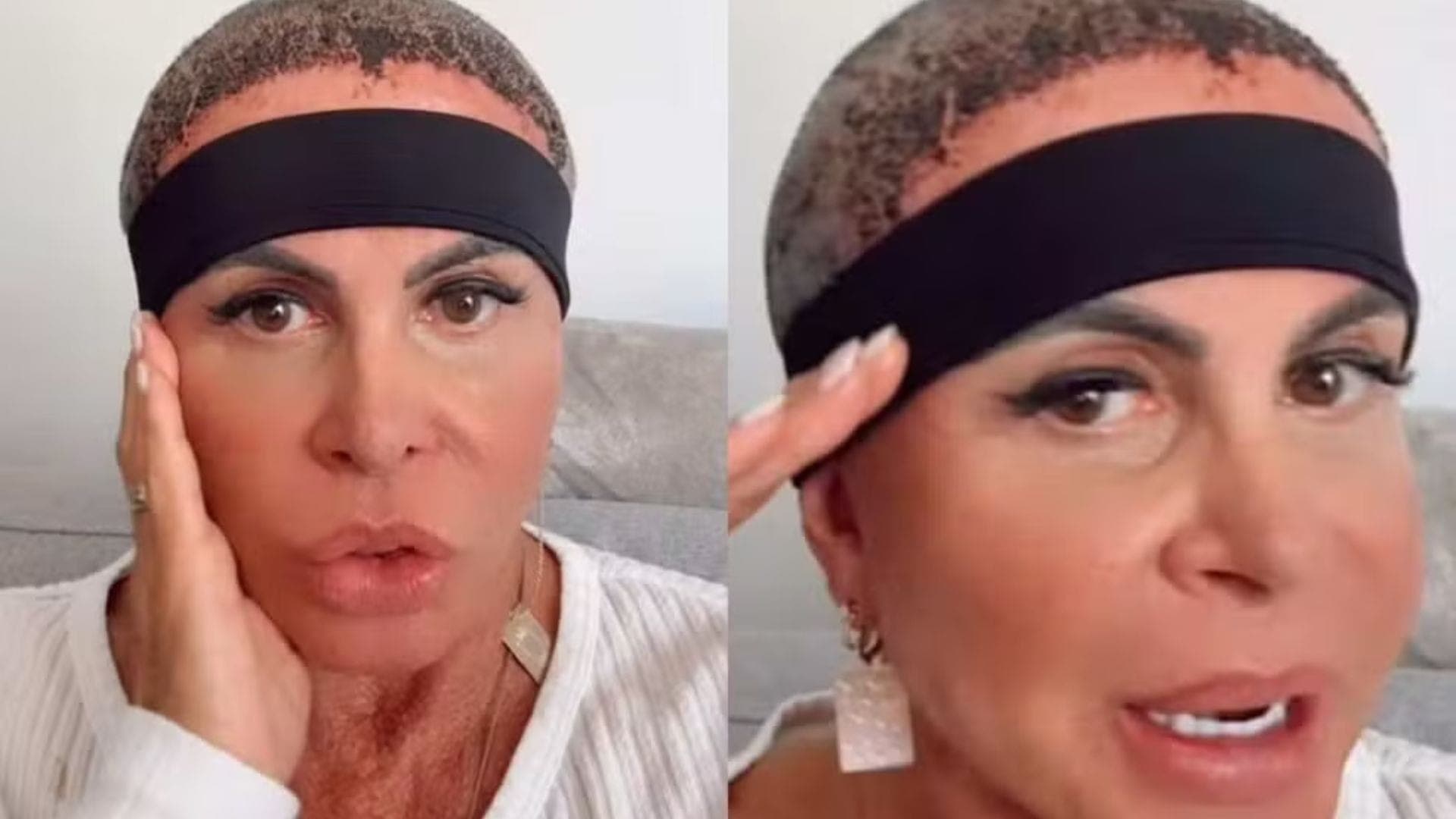 Gretchen fez transplante capilar contra alopecia