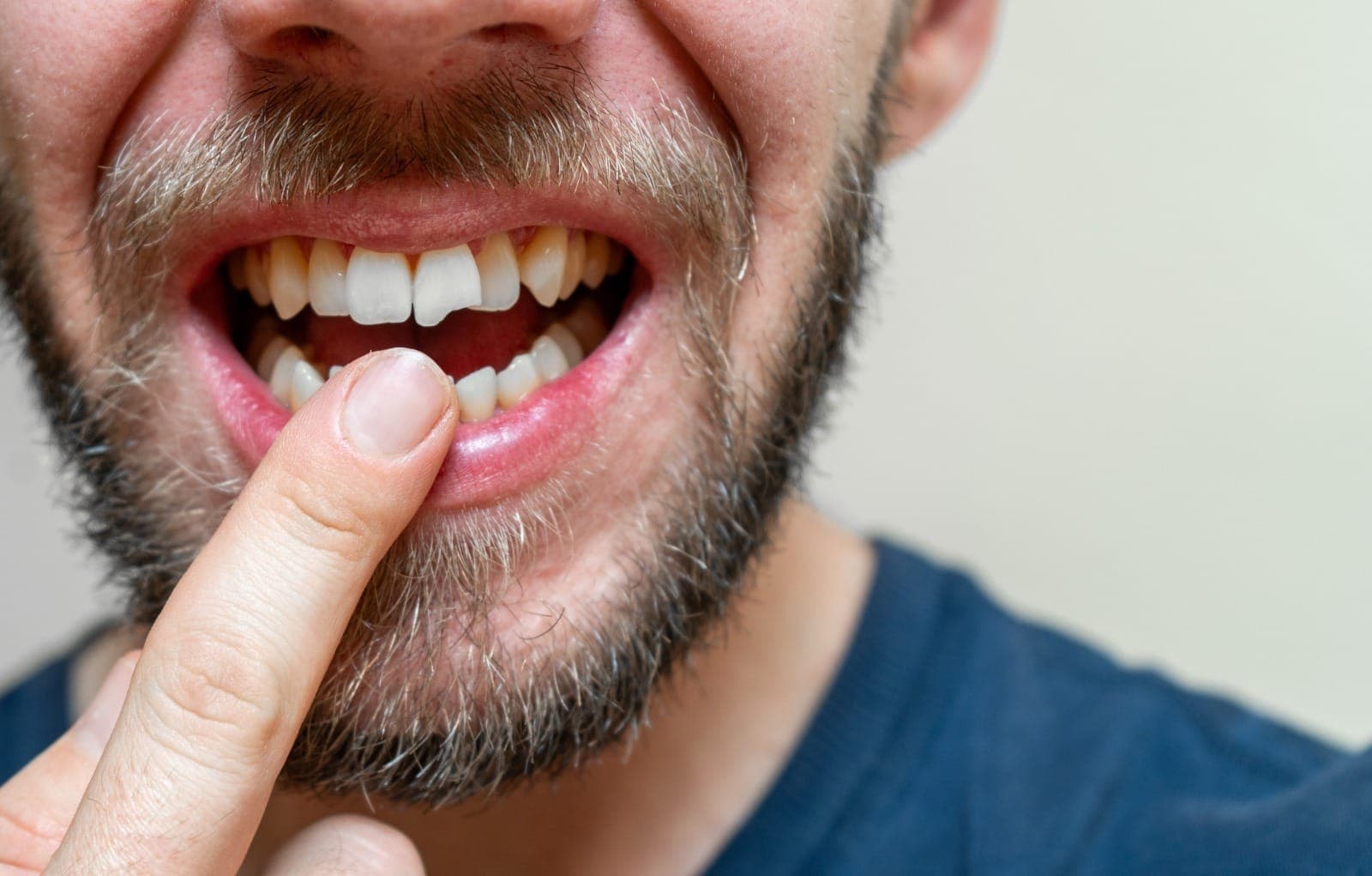 Brasil teve 1,65 milhão de casos de traumatismos dentários entre 2014 e 2023