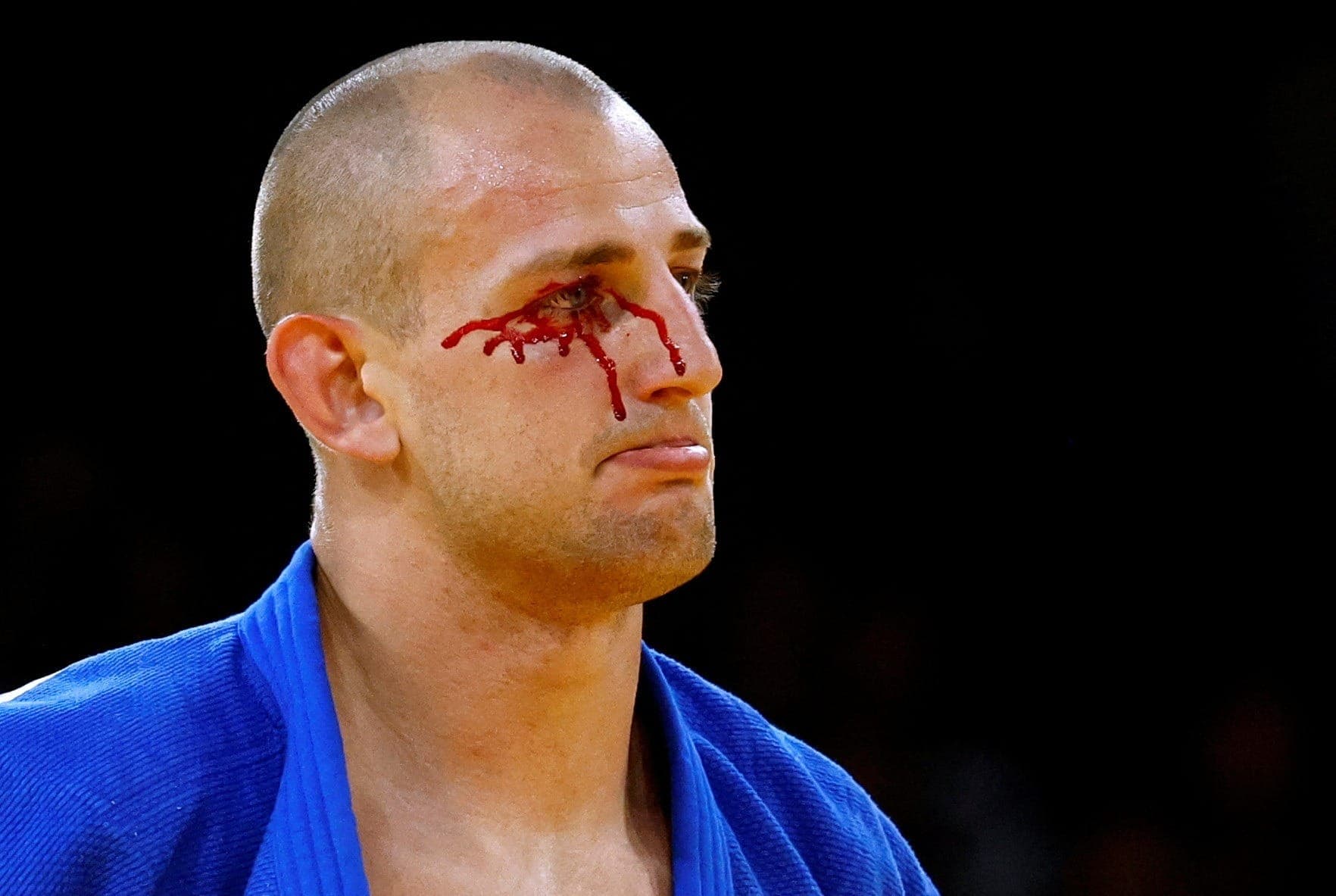 Judoca Piotr Kuczera com o olho sangrando após derrota para Zelym Kotsoiev, do Azerbaijão
