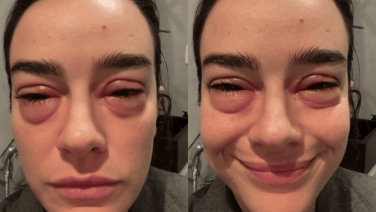 Mariana Molina mostra reação alérgica nos olhos