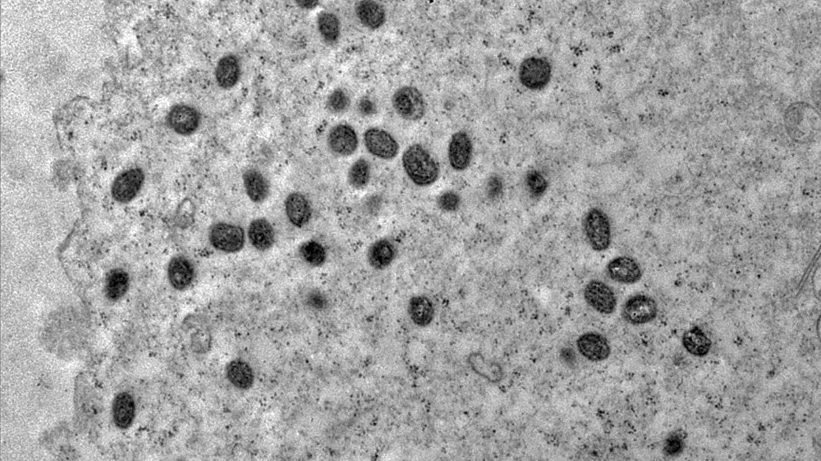 Caso suspeito de Mpox em navio saído do Brasil