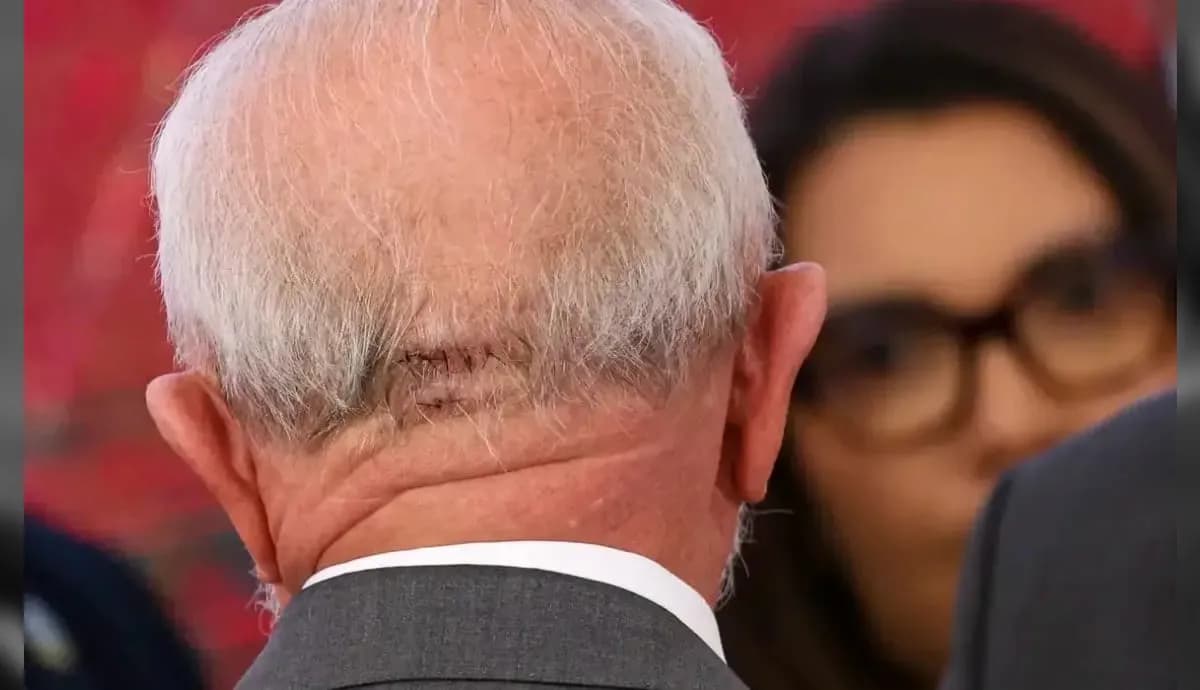 Após acidente doméstico, Lula precisou de pontos na região da nuca